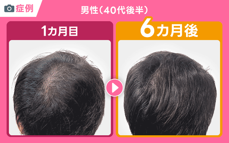 DMM AGA 症例 40代男性