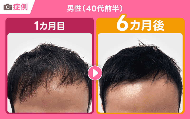 DMM AGA 症例写真